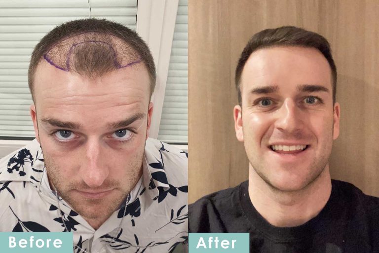 Hair Transplant London – High Success Rates, Real Results