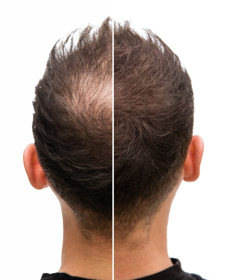 Why Patients Choose Our Hair Transplant Centre Malaysia