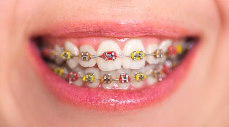 Braces Myrtle Beach: Common Problems and How to Fix Them Fast